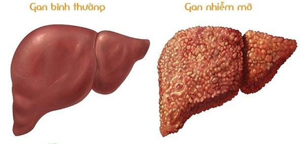 Chế độ ăn cho người bị gan nhiễm mỡ