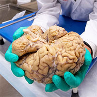 Căn bệnh bí ẩn chỉ được chẩn đoán sau khi bệnh nhân đã chết, bởi bác sĩ cần cắt não của họ