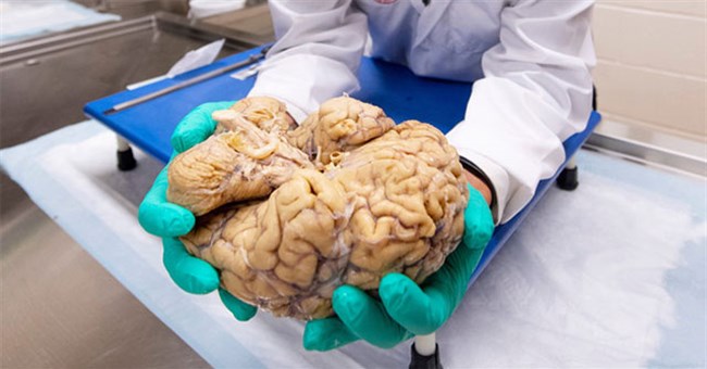 Căn bệnh bí ẩn chỉ được chẩn đoán sau khi bệnh nhân đã chết, bởi bác sĩ cần cắt não của họ