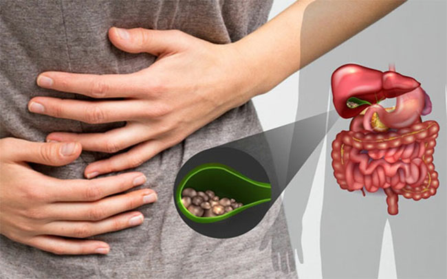 Sỏi mật: Nguyên nhân, triệu chứng và cách điều trị