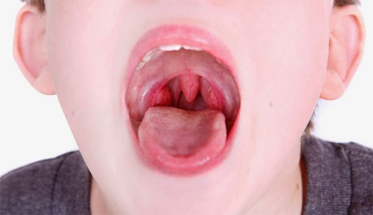 11 nguyên nhân khiến cổ họng có cảm giác bị vướng