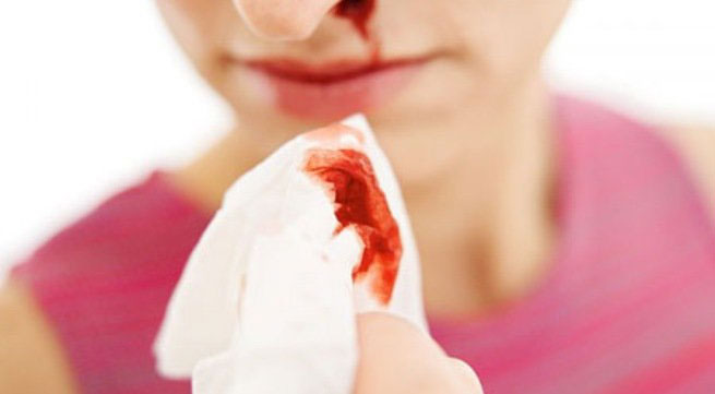 Nước mũi có máu, nguyên nhân do đâu?
