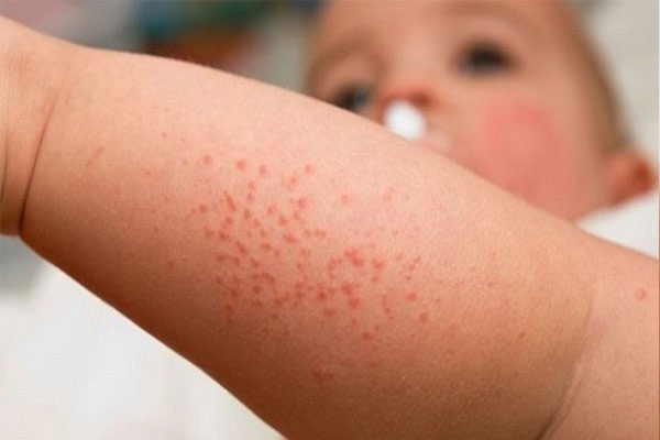 13 nguyên nhân gây nổi mẩn đỏ không ngứa
