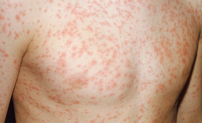 13 nguyên nhân gây nổi mẩn đỏ không ngứa