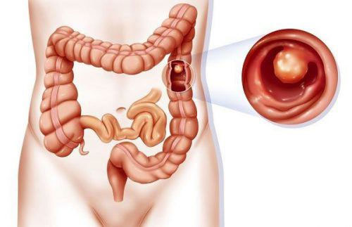 Tại sao lại có cảm giác buồn nôn nhưng không nôn?