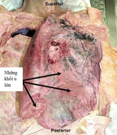 Chất lượng không khí đang báo động, nhà khoa học cảnh báo các loại bệnh do ô nhiễm bụi