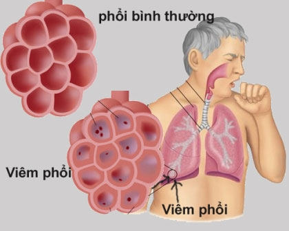 Ảnh hưởng của than tổ ong đến sức khỏe
