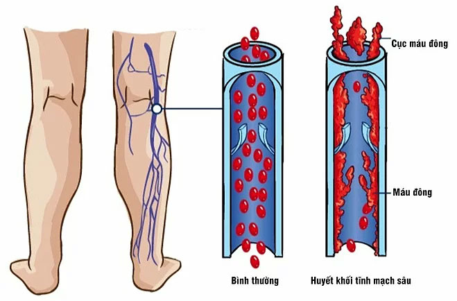 Thuyên tắc huyết khối tĩnh mạch là gì?