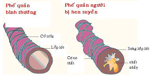 Các bệnh thường gặp vào mùa đông