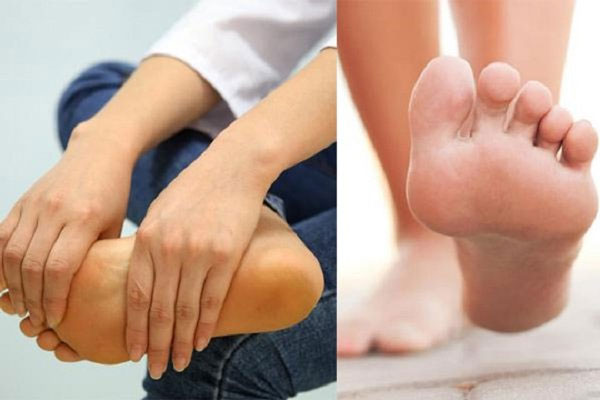 Bệnh Charcot-Marie-Tooth (bệnh teo cơ Mác) là gì?