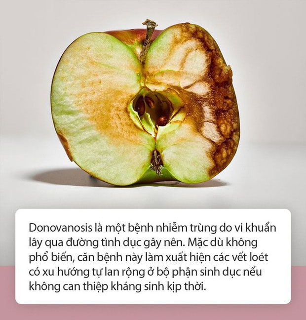 Những điều cần biết về căn bệnh lây truyền qua đường tình dục có thể 