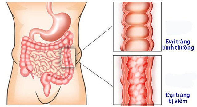 Viêm đại tràng: Nguyên nhân, triệu chứng và cách điều trị