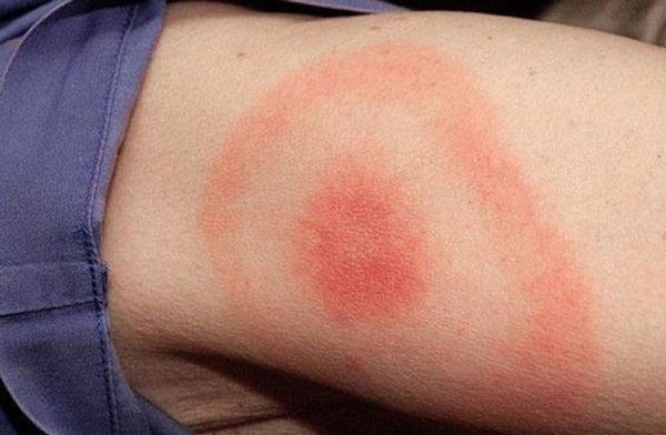 Dấu hiệu của bệnh lyme là một vết sưng nhỏ, màu đỏ, tương tự như vết sưng của vết muỗi đốt.