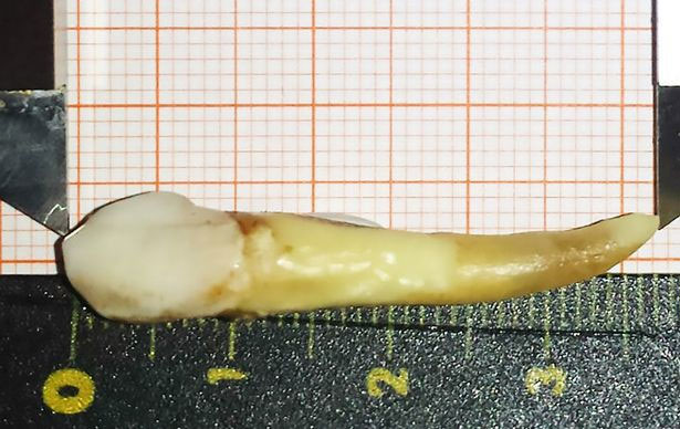 Người đàn ông đi vào sách kỷ lục Guiness vì sở hữu chiếc răng dài gần 4cm