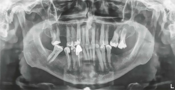 Người đàn ông đi vào sách kỷ lục Guiness vì sở hữu chiếc răng dài gần 4cm
