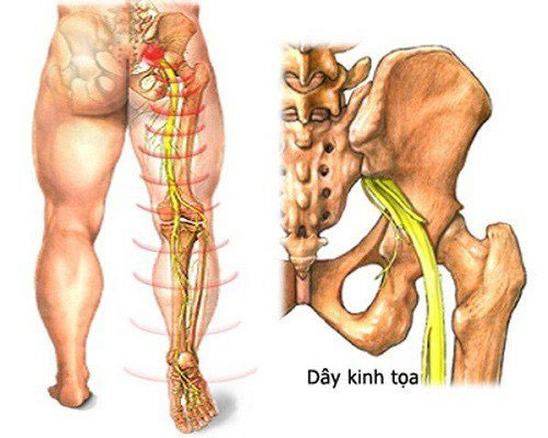 Nguyên nhân và cách điều trị đau thần kinh tọa