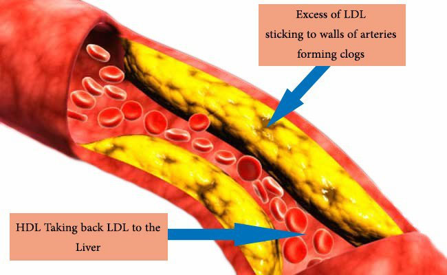 LDL gây vữa xơ động mạch.
