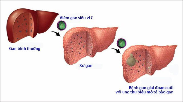 Bệnh viêm gan C: Nguyên nhân, triệu chứng và cách điều trị