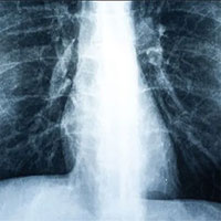 Bệnh nhân đầu tiên trên thế giới phải ghép phổi do hút vape