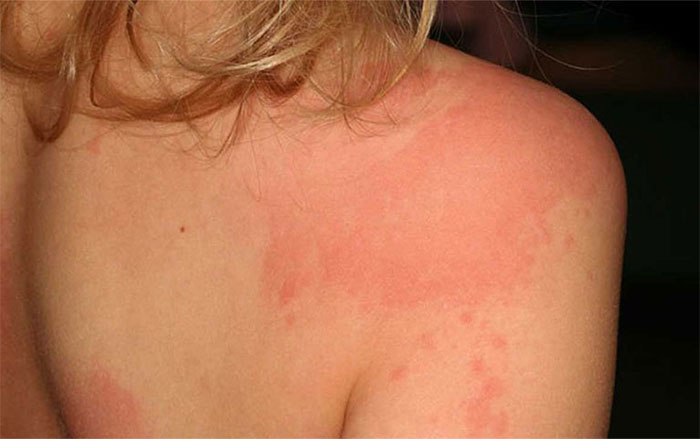 Viêm da dị ứng: Nguyên nhân, triệu chứng và cách điều trị