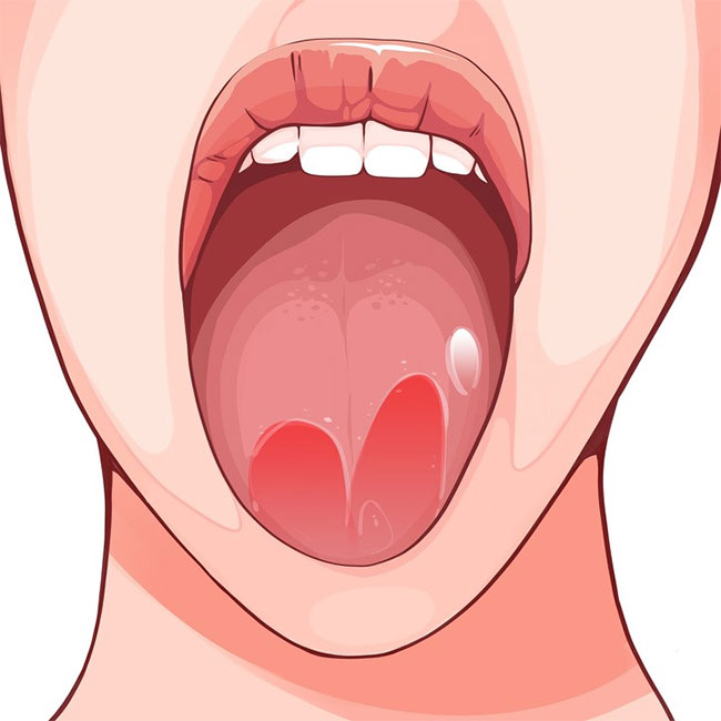 6 sự thay đổi của lưỡi có thể tiết lộ rất nhiều về sức khoẻ