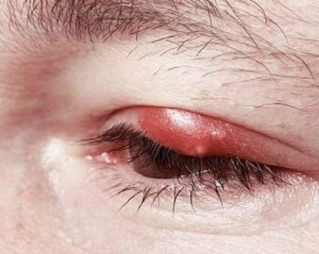 Nổi mụn ở mí mắt trên do đâu?