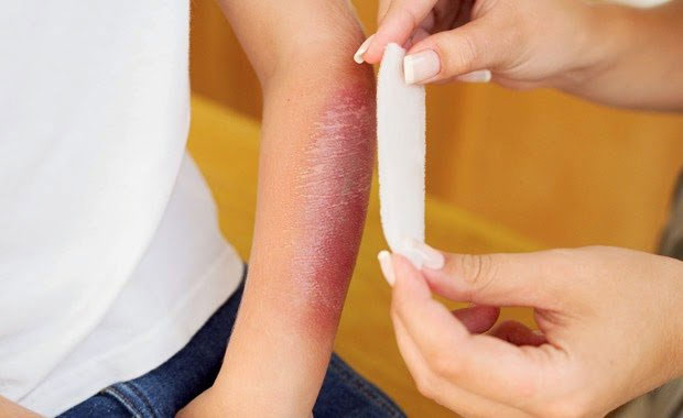 Bị bỏng kiêng ăn gì?
