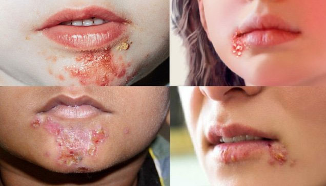 Chốc mép: Nguyên nhân, triệu chứng và cách điều trị