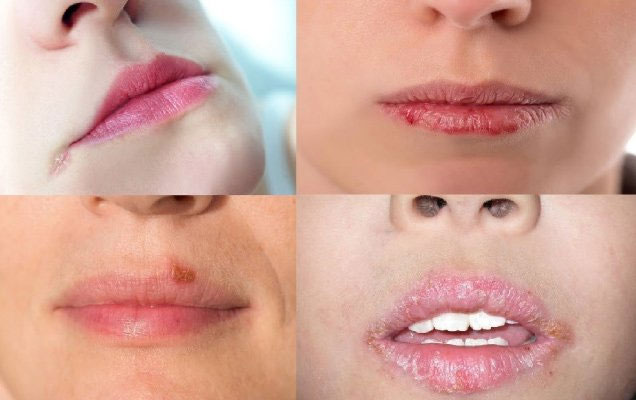 Chốc mép: Nguyên nhân, triệu chứng và cách điều trị