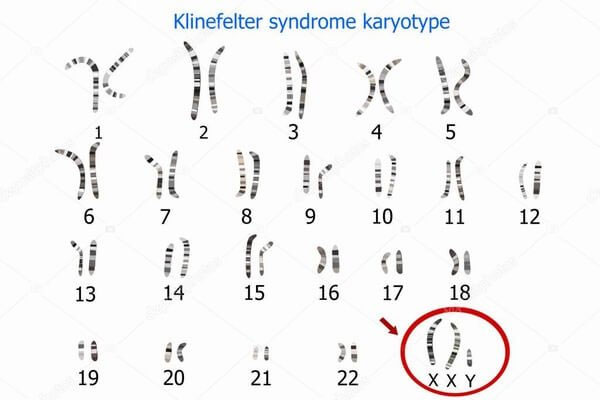 Hội chứng Klinefelter – Những người đàn ông mang gene nữ