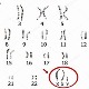 Hội chứng Klinefelter – Những người đàn ông mang gene nữ
