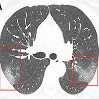 Hình ảnh phổi của bệnh nhân bị virus corona phá hủy