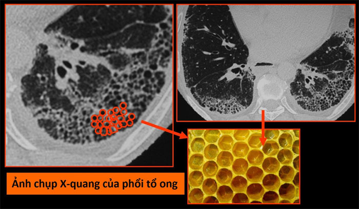 Virus corona mới tàn phá các bộ phận trên cơ thể như thế nào?
