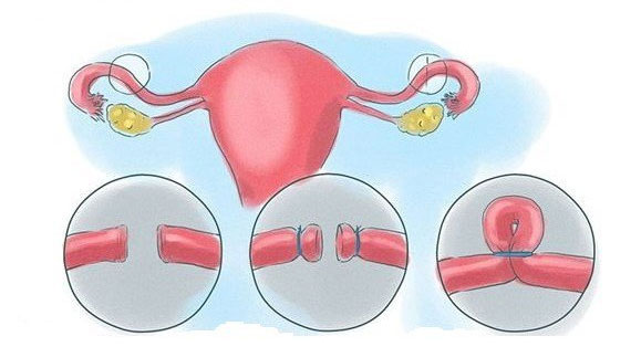 Những điều cần biết về triệt sản ở nam và nữ