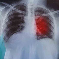 Phương pháp đột phá đưa phổi ra khỏi cơ thể để "làm sạch" ung thư