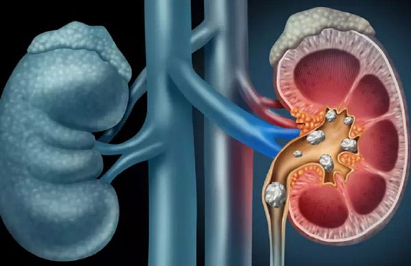 Not drinking enough water and a high sodium diet can lead to kidney stones.