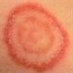 Bệnh hắc lào: Nguyên nhân, triệu chứng và cách điều trị