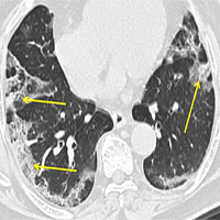 Không giống viêm phổi thông thường: Điều gì xảy ra với phổi của bệnh nhân nhiễm covid-19?