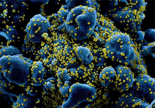 Bão cytokine - hiện tượng khiến cơ thể tự hủy hoại trước virus corona