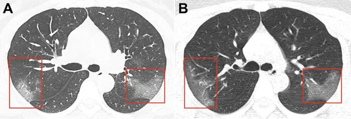 Ảnh chụp CT phổi của bệnh nhân Covid-19. Các mảng trắng mờ cho thấy phổi đầy dịch