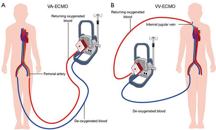 ECMO là gì? Khi nào bệnh nhân cần can thiệp ECMO?