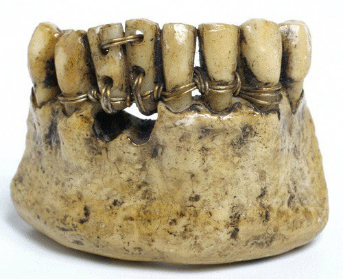 Người xưa lấy răng của binh sĩ tử trận để làm răng giả.