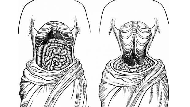 Tác hại khôn lường của đai nịt bụng 