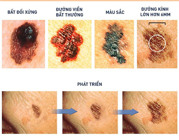 Lông mọc ở nốt ruồi không gây ung thư và có thể cắt bỏ được: Sự thật có phải vậy không?