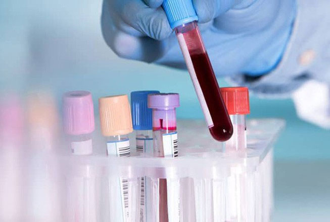 Các nhà khoa học đã tìm ra nguồn gốc của đông máu do Covid-19