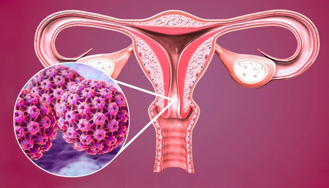 Các bệnh nhân mắc ung thư cổ tử cung đa phần có tiền sử nhiễm virus HPV.