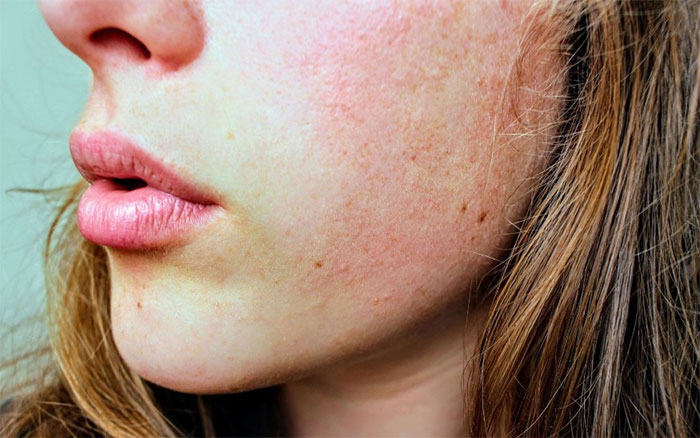 Những lầm tưởng về bệnh eczema