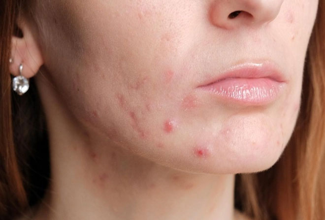 5 ngộ nhận về mụn trứng cá chúng ta thường gặp