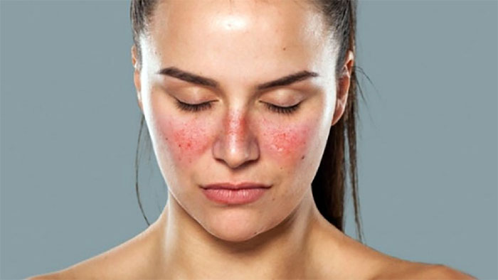 Lupus ban đỏ và vảy nến khác nhau như thế nào?