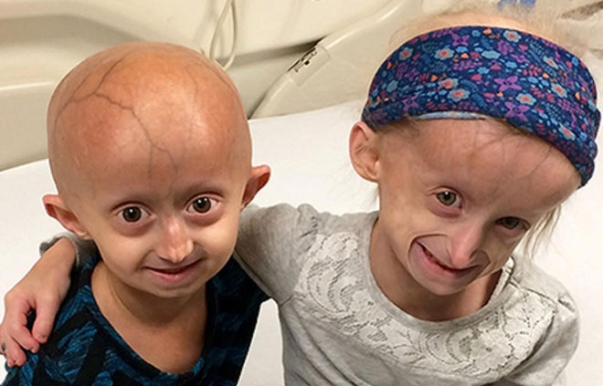 Trẻ mắc Progeria thường không sống quá 15 tuổi.